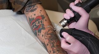 tattoo removal service edmonton Urban Lasers & Aesthetics